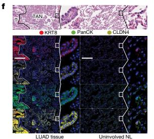 Fig.2f：LUAD/TAN multiplex imaging 定位 KRT8/CLDN4-high KAC-rich regions。