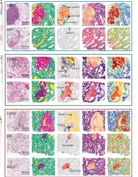 Fig.2C: 保留代表病例的 pathology、clone map、pseudotime 与 CytoTRACE；pattern 定义和 driver summary 回到原文。