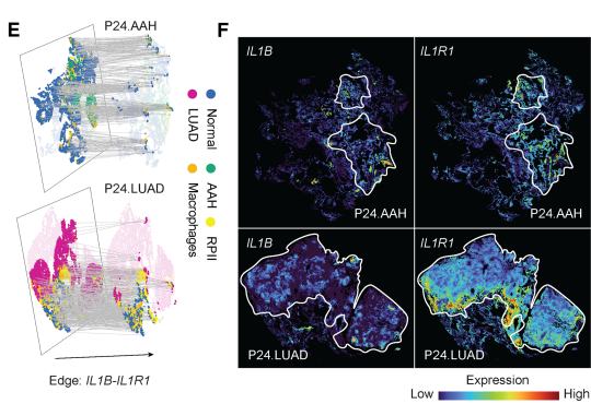 Fig.4E-F: 用 paired AAH/LUAD interface map 让读者看见 IL1B 与 IL1R1 的空间关系。