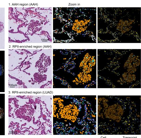 Fig.5F: 保留 AAH/RPII/LUAD zoom 与 IL1B/IL1R1 cell/transcript maps 作为独立验证锚点。