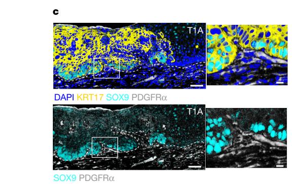 Fig.5c：T1a human ESCC 中 SOX9-positive tumour cells 与 PDGFRalpha-positive fibroblast attraction。